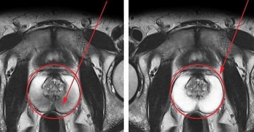 Próstata antes y después de Rhino Gold