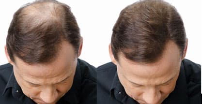 Hombre antes y después de Rhino Gold 2